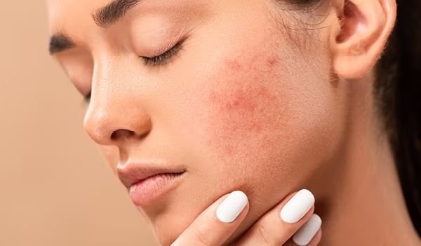 How to Get Clear Skin: Tips for Acne Prone Skin?